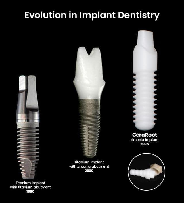 Dental Implants Evolution